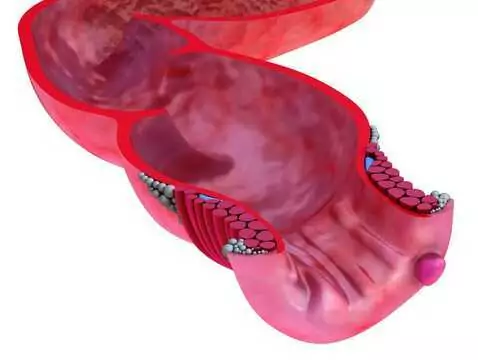 Thrombusbildung und -entwicklung - tiefe Venenthrombose