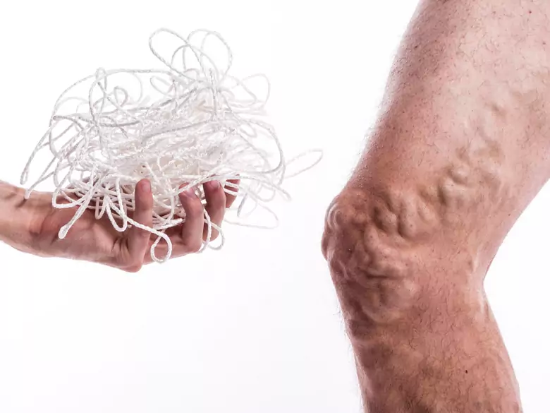 Wie geht man mit Problemen mit Krampfadern um?