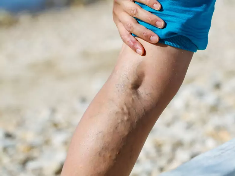 Wie geht man mit Problemen mit Krampfadern um?